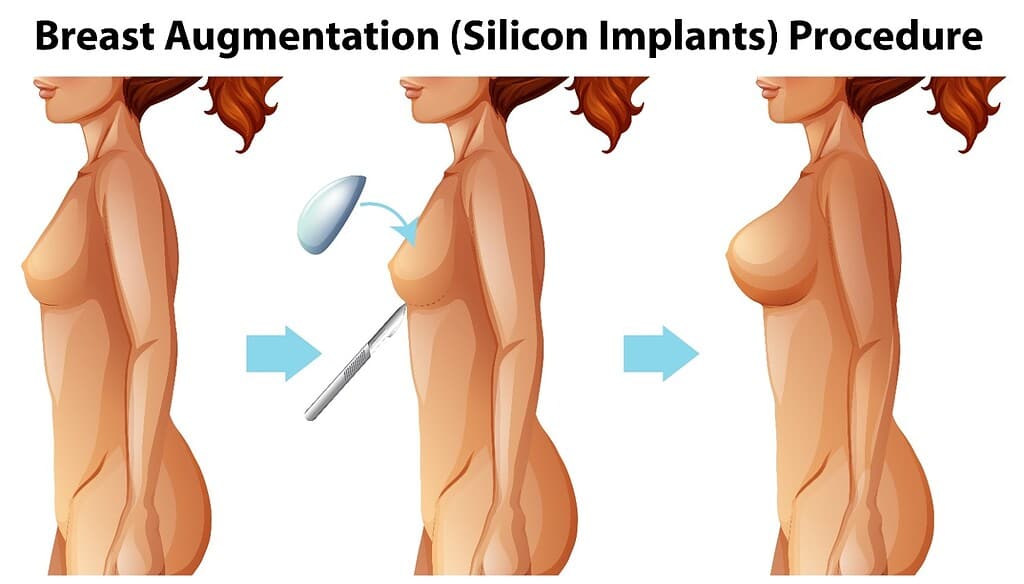 Breast augmentation with silicone implants showing before and after images.
