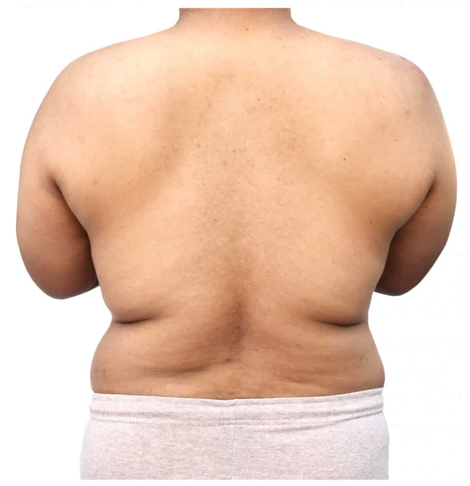 Male back with excess fat and skin, showing areas for liposuction treatment.