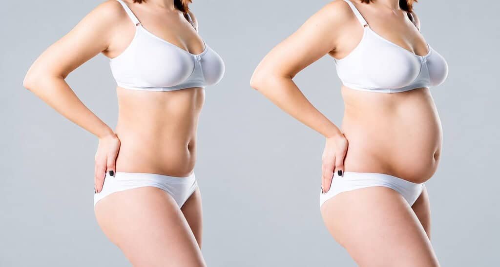 Pregnant woman before and after abdominoplasty surgery comparison.
