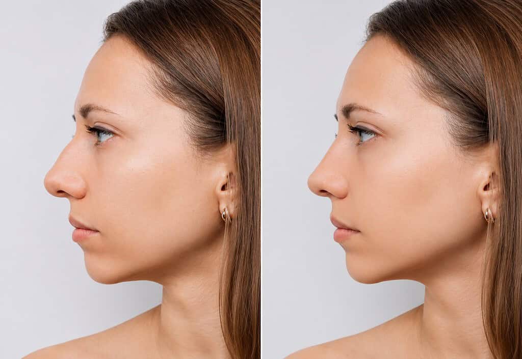 Side profile of woman showing nose correction after surgery.