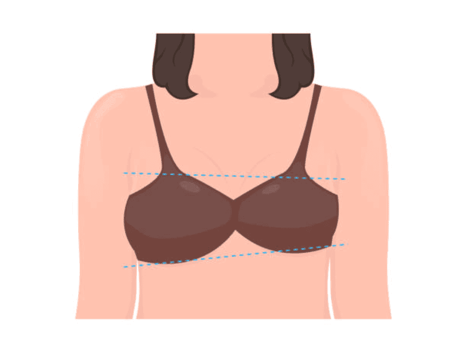 Illustration of breast asymmetry with different sizes and shapes.