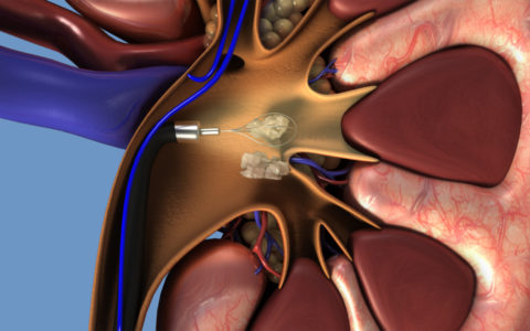 Kalkuloza Renale (gurët në veshka) dhe trajtimi ureteroskopik