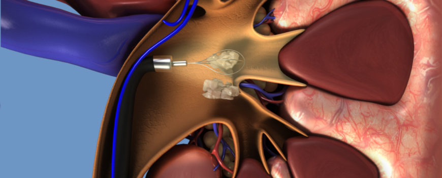 Kalkuloza Renale (gurët në veshka) dhe trajtimi ureteroskopik
