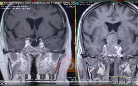 Ndërhyrjet e bazës kraniale në Spitalin Amerikan 1