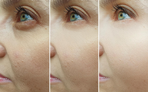 Çfarë është blefaroplastia?