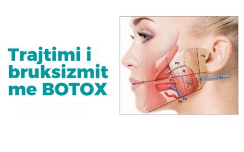 Trajtimi i bruksizmit me botox
