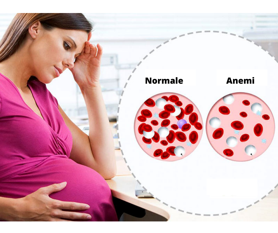 Железодефицитная анемия и беременность. Жда при беременности. Беременные с анемией. Профилактика анемии у беременных. Железо при беременности 3