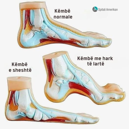 Këmbët e sheshta dhe këmbët me hark të lartë

Këmbët e sheshta

Këmbët e sheshta, të quajtura edhe harqe të rrëzuara, ndodhin kur tendinat dhe ligamentet në harkun e këmbës dobësohen dhe bien. Shumica e njerëzve me këmbë të sheshta i zhvillojnë ato me kalimin e kohës (këmbë e sheshtë e fituar) për shkak të lëndimit ose artritit. Të tjerë lindin me këtë gjendje, megjithëse mund të mos vërejnë simptoma deri vonë.

Simptomat e harqeve të rënë mund të përfshijnë:

- Ënjtje e kyçit të këmbës
- Këmbët që ndjehen të lodhura ose të dobëta
- Pamundësia për të qëndruar në këmbë ose për të ecur për periudha të gjata kohore
- Dhimbje në thembër ose në harkun e këmbës

Të kesh këmbë të sheshta mund të ndryshojë mënyrën se si ecni. Ju mund të bëni presion në zona të tjera të këmbëve, të cilat mund të çojnë në zhvillimin e patologjive të tjera.

Diabeti mund të çojë në një formë të këmbës së sheshtë të quajtur këmba “Charcot”. Kjo gjendje ndodh kur kockat e këmbës thyhen dhe bien për shkak të rrjedhjes së dobët të gjakut. 

Këmbët me hark të lartë

Ashtu si këmbët e sheshta, harqet e larta shkaktohen gjithashtu nga problemet e kockave dhe indeve të buta në këmbë. Megjithatë, harqet e larta (këmba cavus) janë pothuajse gjithmonë të trashëguara ose rezultat i një gjendjeje neurologjike. Spina bifida, paraliza cerebrale dhe sëmundja Charcot-Marie-Tooth janë disa nga shkaqet më të zakonshme.

Simptomat e harqeve të larta mund të përfshijnë:

- Paqëndrueshmëria e kyçit të këmbës
- Dhimbje në mesin e shputës
- Kallo
- Dhimbje në thembër

Për më shumë informacion ose vizitë me mjekët tanë kontaktoni në 042357535 ose klikoni në: rezervime.spitaliamerikan.com

Spitali Amerikan, përqafoje jetën!